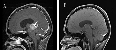 Intracranial Germinoma Misdiagnosed as Hyperthyroidism: A Case Report and Review of the Literature